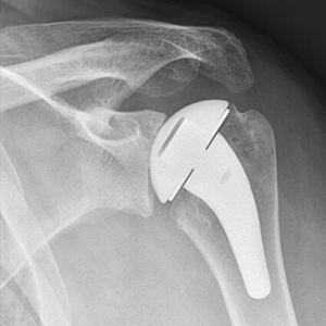 Pyrocarbon hemiarthroplasty