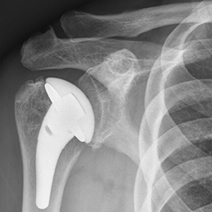 Pyrocarbon hemiarthroplasty